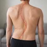 Escoliosis y curvatura de la columna vertebral